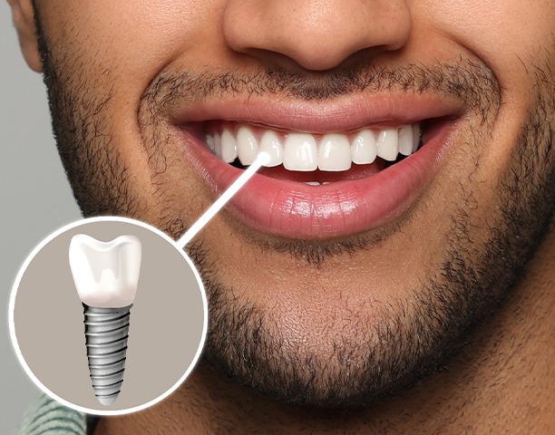 Nose-to-chin view of man smiling with one tooth indicated as an implant