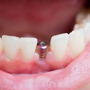 A closeup of a dental implant abutment