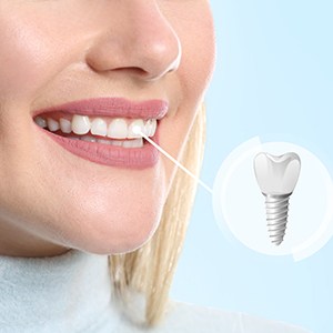 A photo highlighting a woman’s complete dental implant