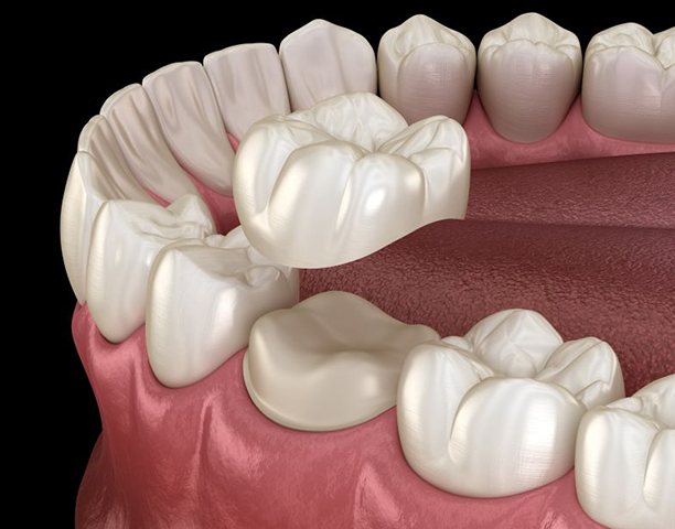 Illustration of a dental crown being placed on a prepared tooth
