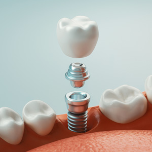 A 3D rendering of the parts of a dental implant