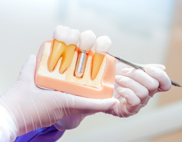 Gloved hands holding and pointing to model of dental implant