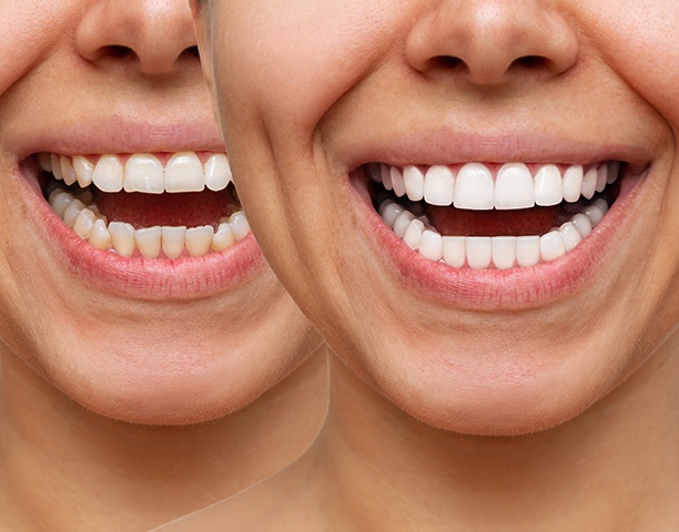 Veneers can transform multiple aspects of your smile in just one treatment