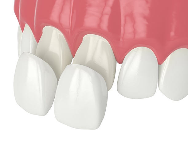 Dental veneers are thin porcelain shells that fit over your teeth to transform their appearance