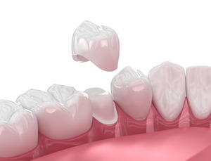 Illustration of CEREC crown being placed on tooth
