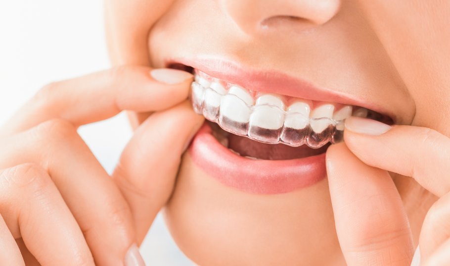 Woman putting on clear aligner